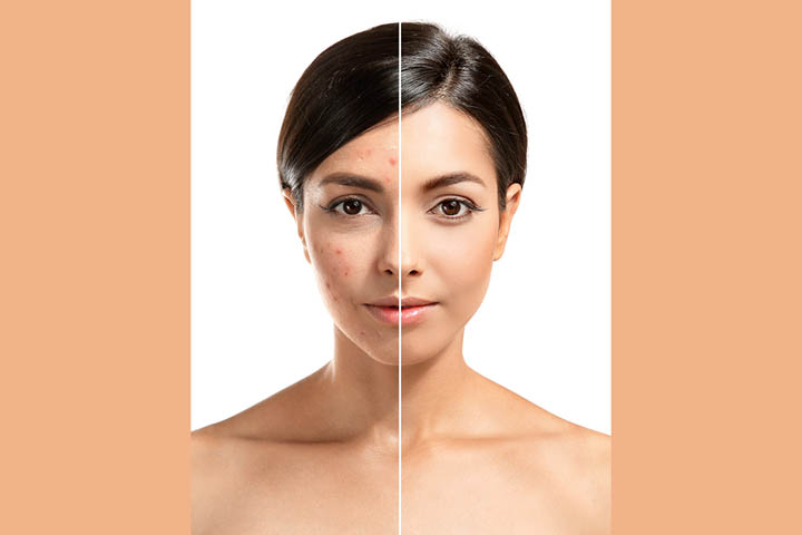 Acne scars treatment