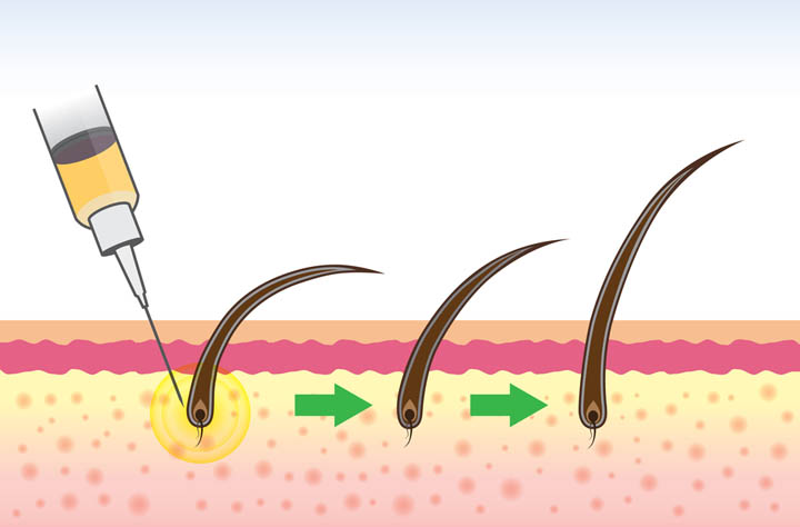 Autologous Stem Cells