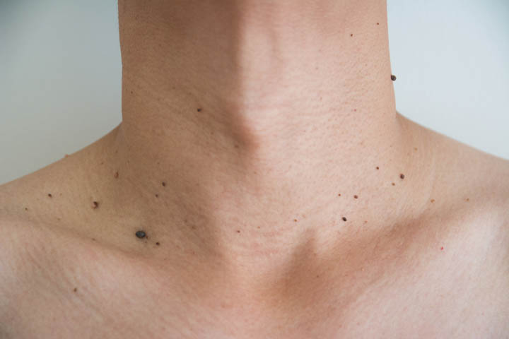 Wart Removal Skin Tag Removal